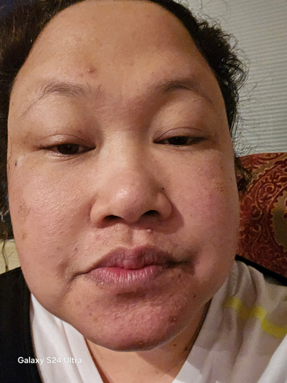 Queenie A., 45 After