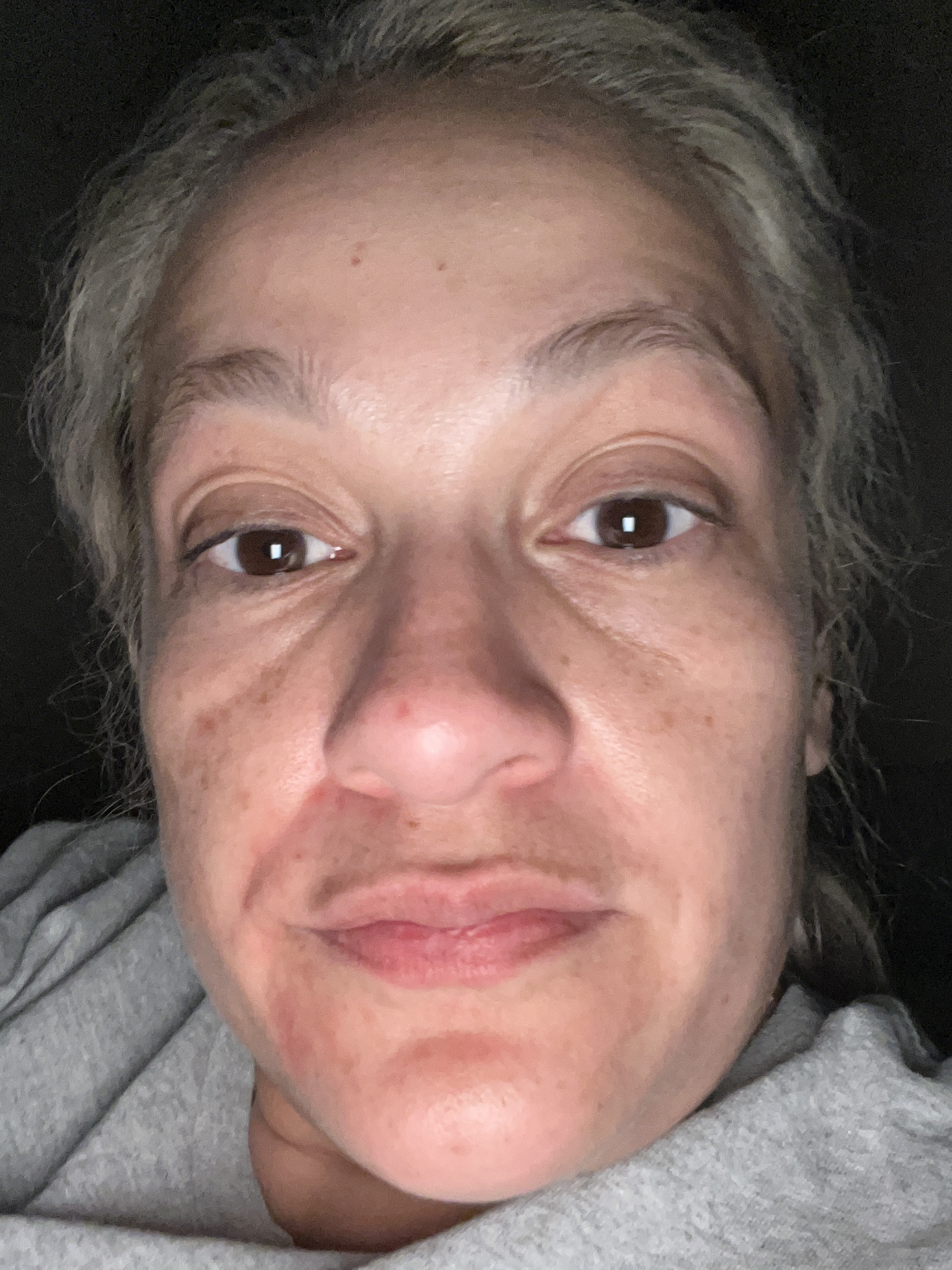Nancy R., 41 After