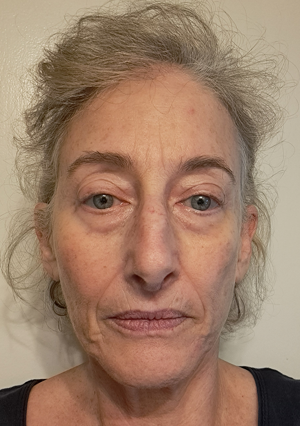 Julie B., 63 After